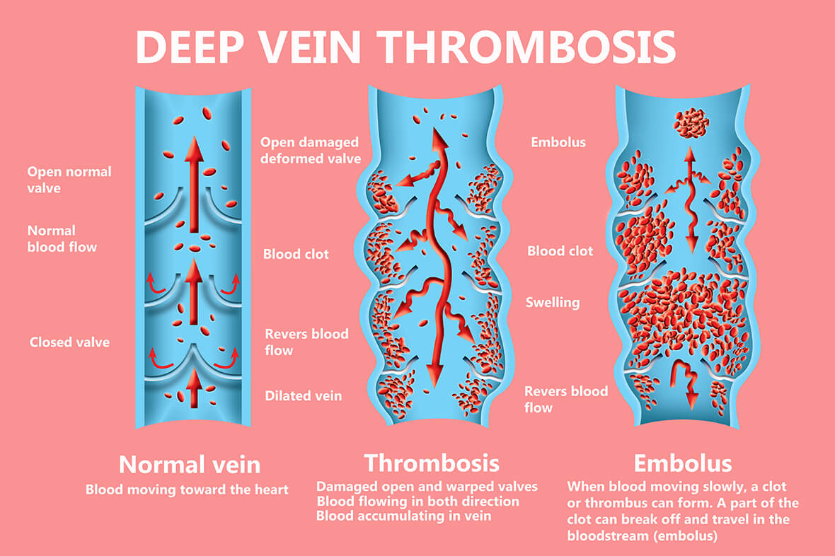 Thrombose ist die Bildung eines Blutgerinnsels in einem Blutgefäß. 