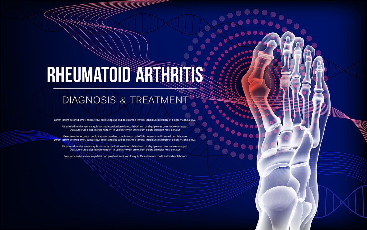 Rheumatoide Arthritis (RA) ist eine chronische Autoimmunerkrankung, die hauptsächlich die Gelenke beeinflusst